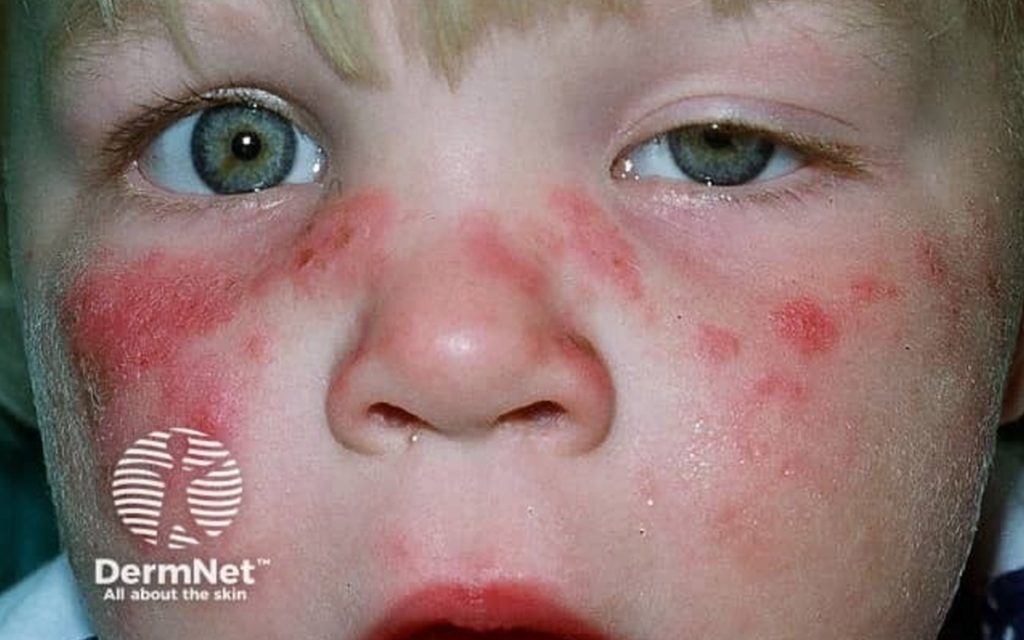 Heat Rash Kids Rfch Heat Rash in Children: A Paediatrician's Guide | Empaediatrics